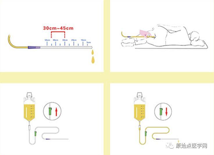 精华汇总 | 原始点医学之姜的应用（新增灌肠部分）201808第13版
