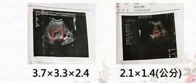 肾上腺瘤免除手术案例-七不姜 生姜养生网-明德CSA生态姜园&明安农业