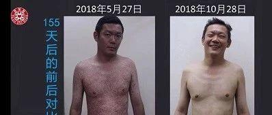 牛皮癣案例(马来西亚)-七不姜 生姜养生网-明德CSA生态姜园&明安农业