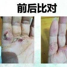 手部外伤案例-七不姜 生姜养生网-明德CSA生态姜园&明安农业