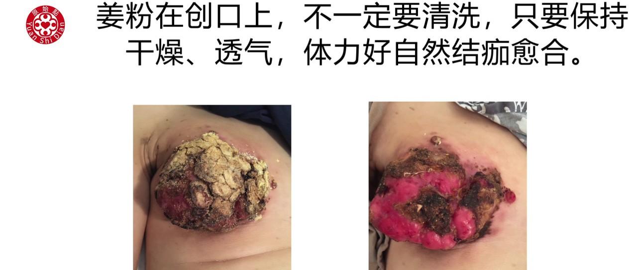 乳癌处理解说-七不姜 生姜养生网-明德CSA生态姜园&明安农业