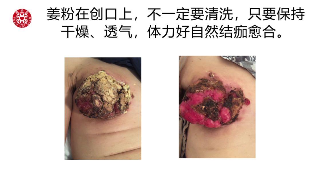 乳癌处理解说 乳癌处理解说