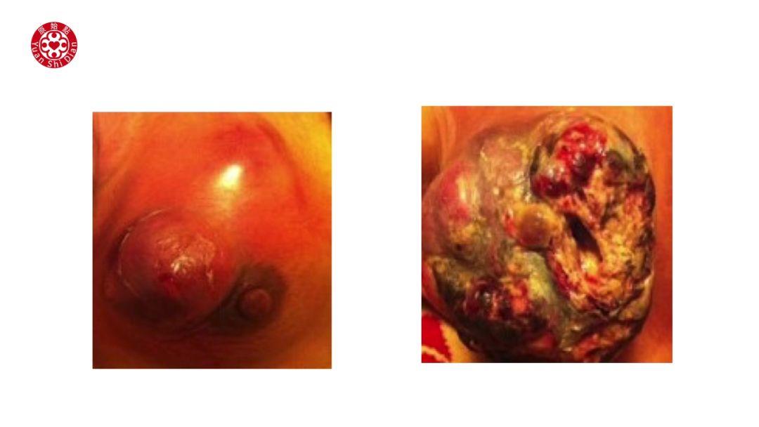 乳癌处理解说 乳癌处理解说