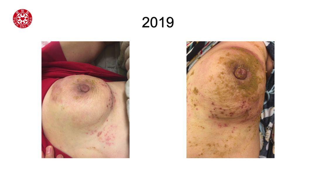 乳癌处理解说 乳癌处理解说