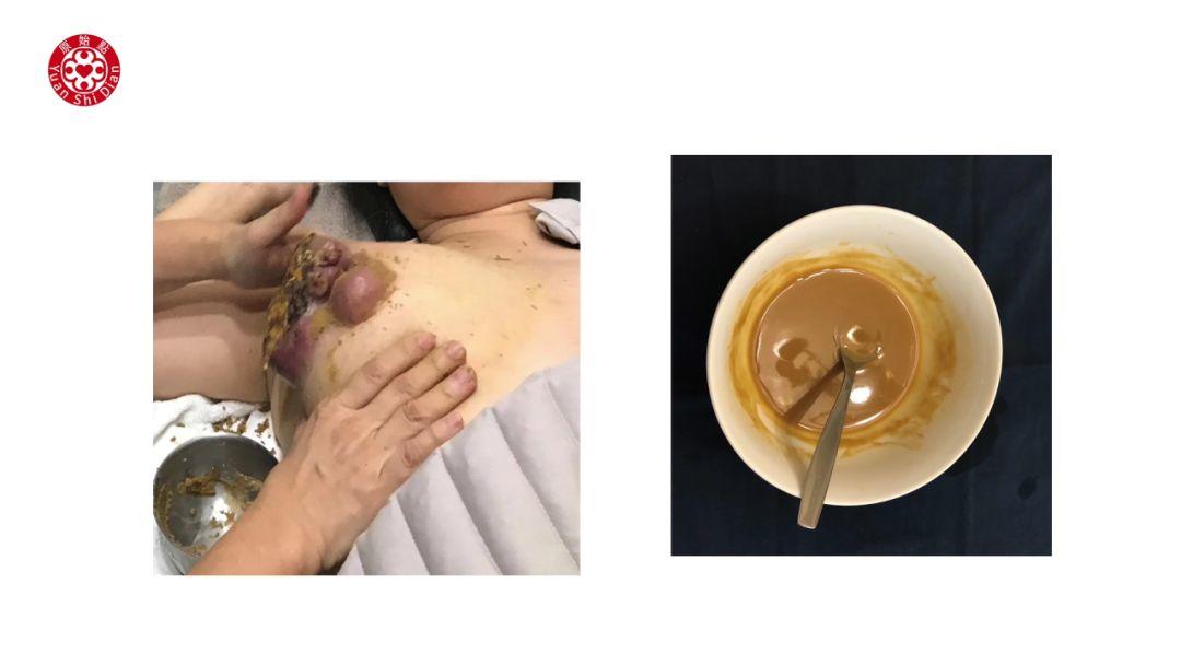 乳癌处理解说 乳癌处理解说