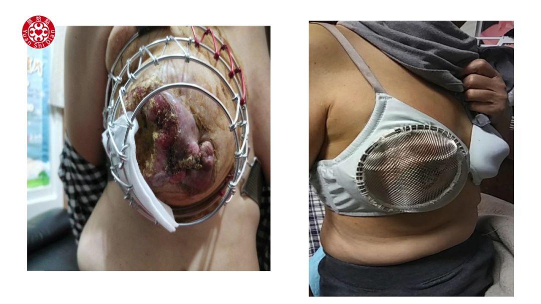 乳癌处理解说 乳癌处理解说