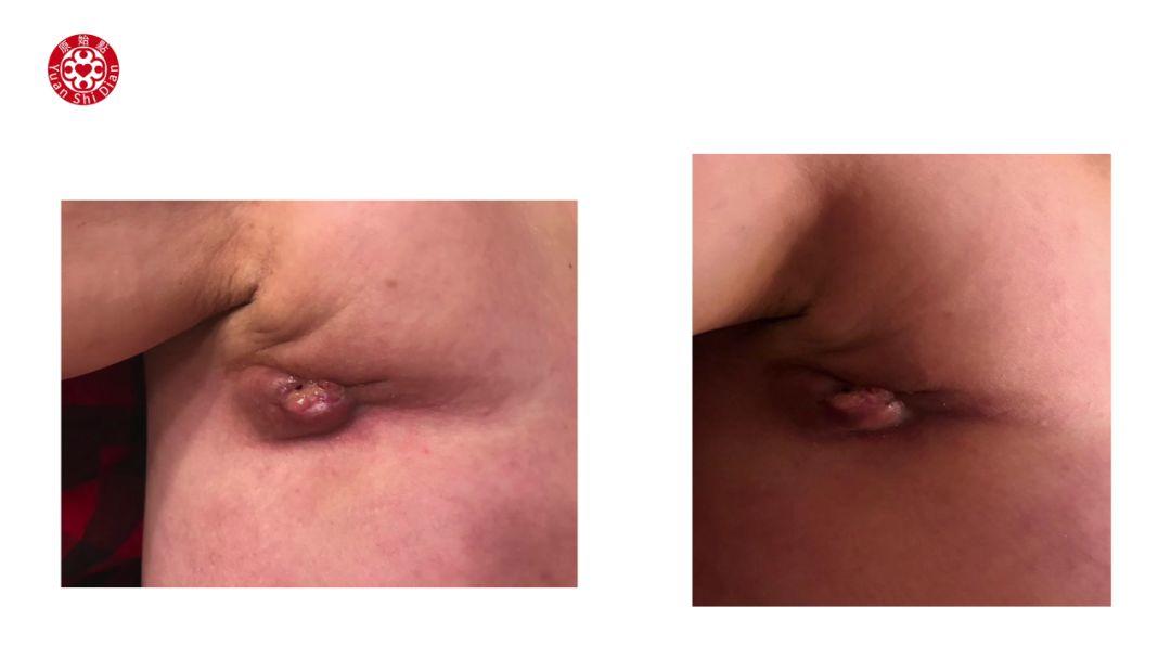 乳癌处理解说 乳癌处理解说