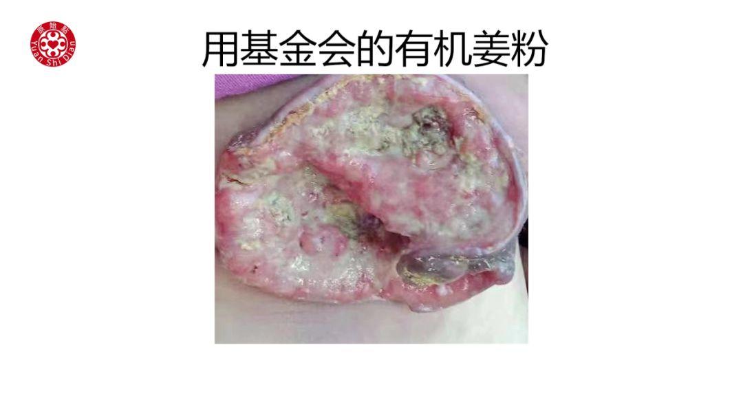 乳癌处理解说 乳癌处理解说