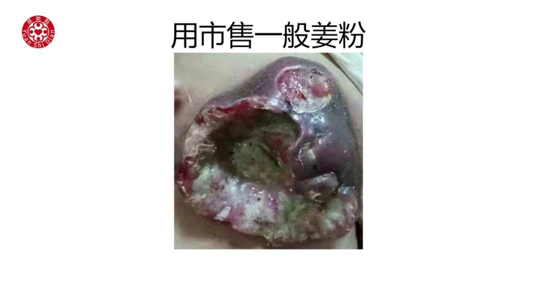 乳癌处理解说 乳癌处理解说