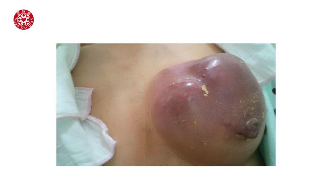 乳癌处理解说 乳癌处理解说