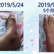 类风湿关节炎案例-七不姜 生姜养生网-明德CSA生态姜园&明安农业