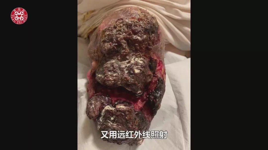 乳癌案例(2)-红肿胀痛储出血(纽约) 乳癌案例(2)-红肿胀痛储出血(纽约)