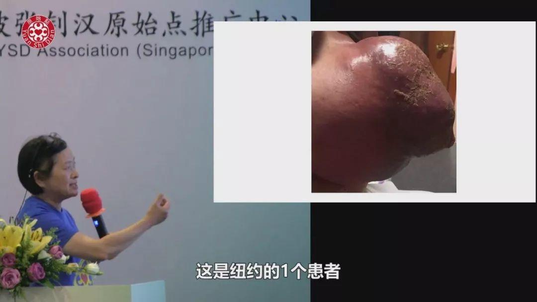 乳癌案例(2)-红肿胀痛储出血(纽约)