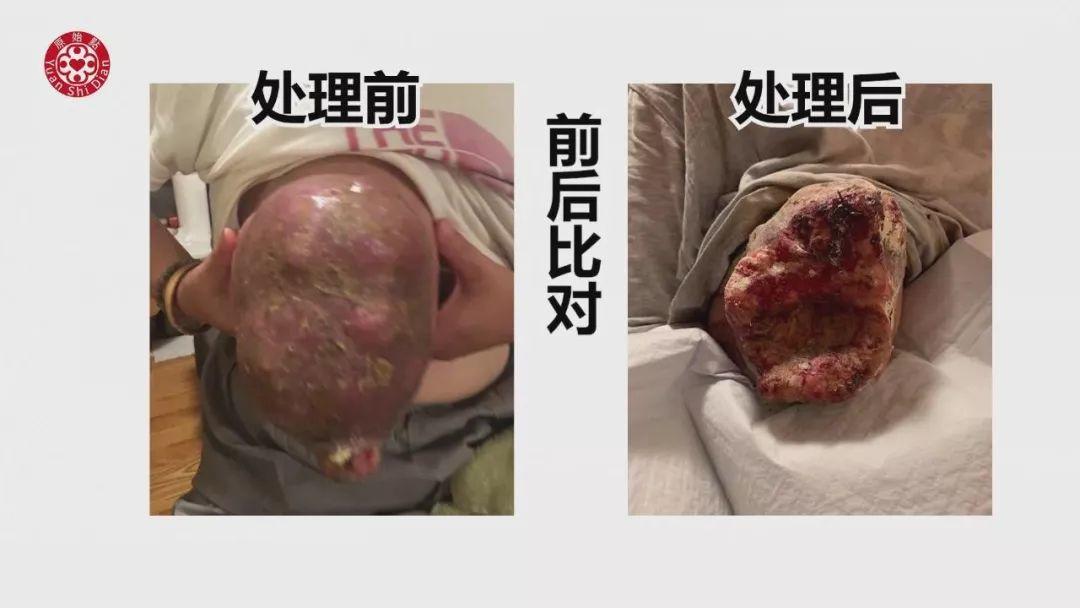 乳癌案例(2)-红肿胀痛储出血(纽约) 乳癌案例(2)-红肿胀痛储出血(纽约)