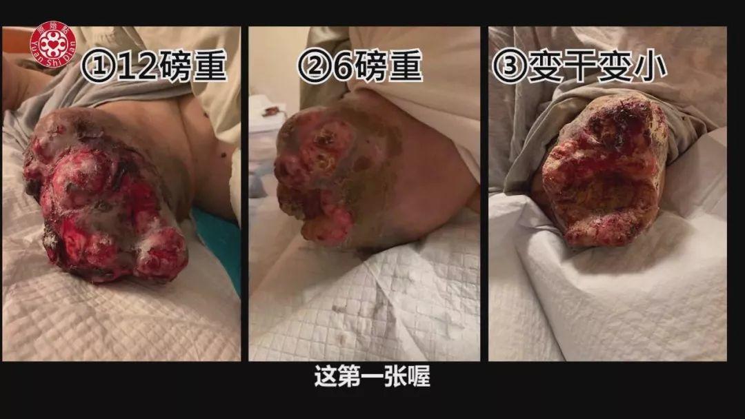 乳癌案例(2)-红肿胀痛储出血(纽约) 乳癌案例(2)-红肿胀痛储出血(纽约)