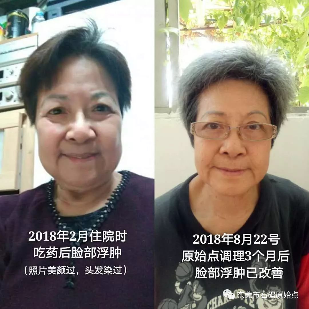 70岁钟婆婆香港人晚期肺癌用原始点调理