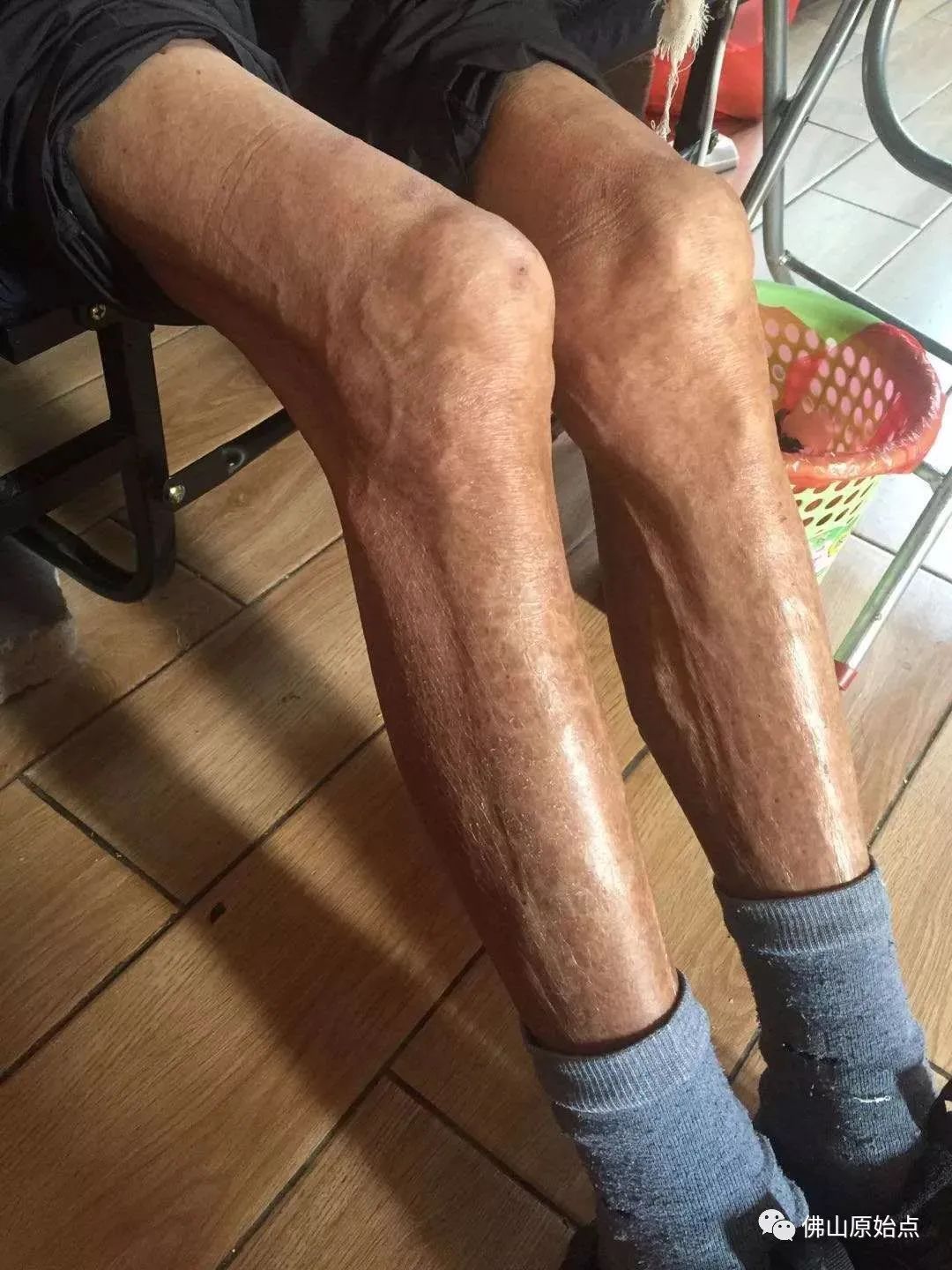 肺癌案例集合福建福清、广州麦女士、江西萍乡、广东潮安县李先生原始点调理肺癌案例集合 肺癌案例集合福建福清、广州麦女士、江西萍乡、广东潮安县李先生原始点调理肺癌案例集合