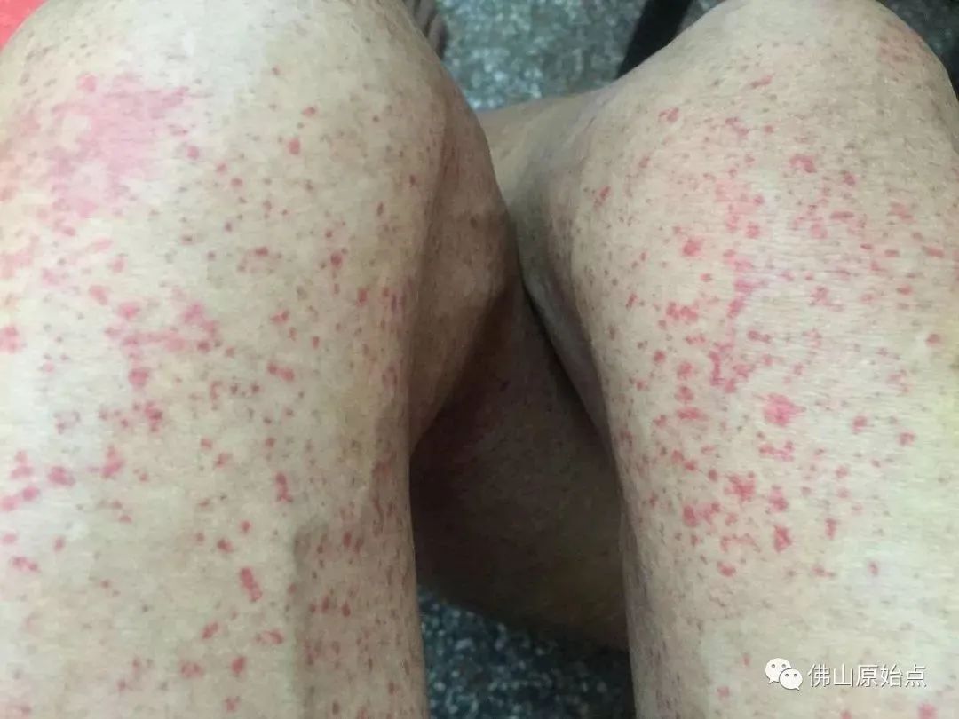 肺癌案例集合福建福清、广州麦女士、江西萍乡、广东潮安县李先生原始点调理肺癌案例集合 肺癌案例集合福建福清、广州麦女士、江西萍乡、广东潮安县李先生原始点调理肺癌案例集合