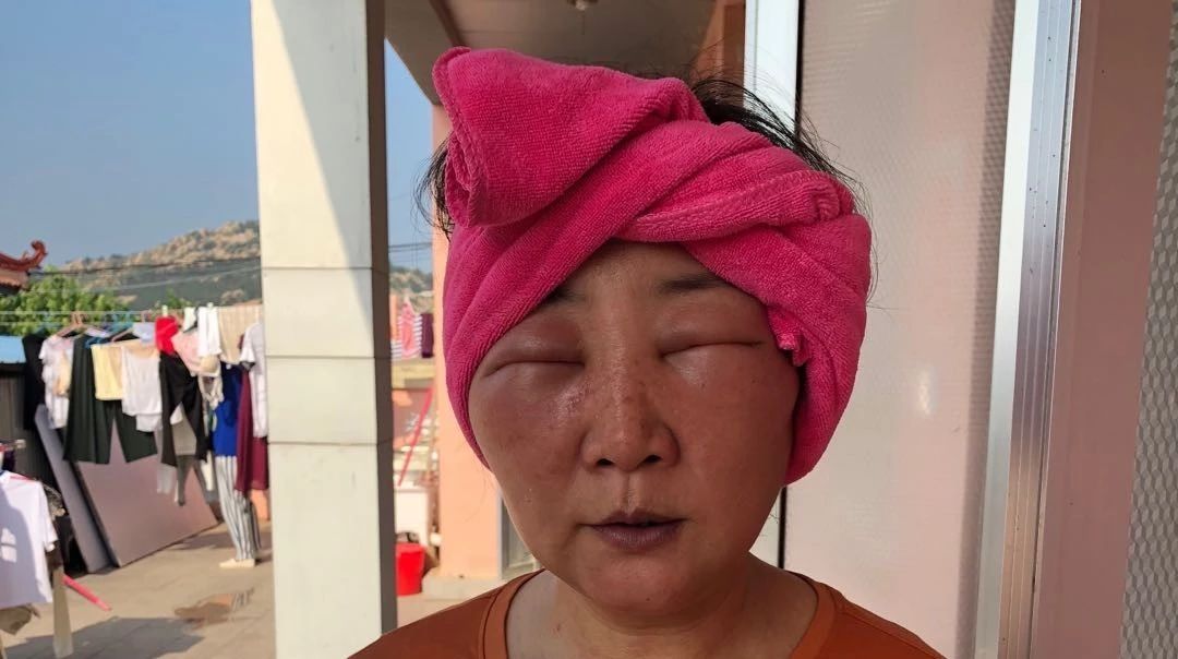 山东原始点案例:化妆品过敏脸部浮肿-七不姜 生姜养生网-明德CSA生态姜园&明安农业