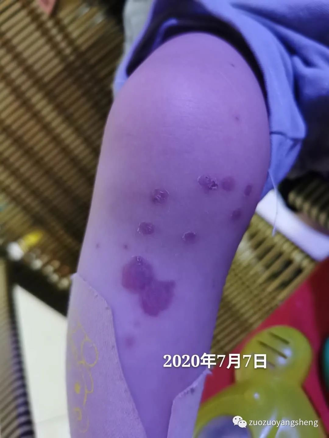 案例分享:原始点调理两岁儿童全身脓包溃烂流脓案例。 案例分享:原始点调理两岁儿童全身脓包溃烂流脓案例。