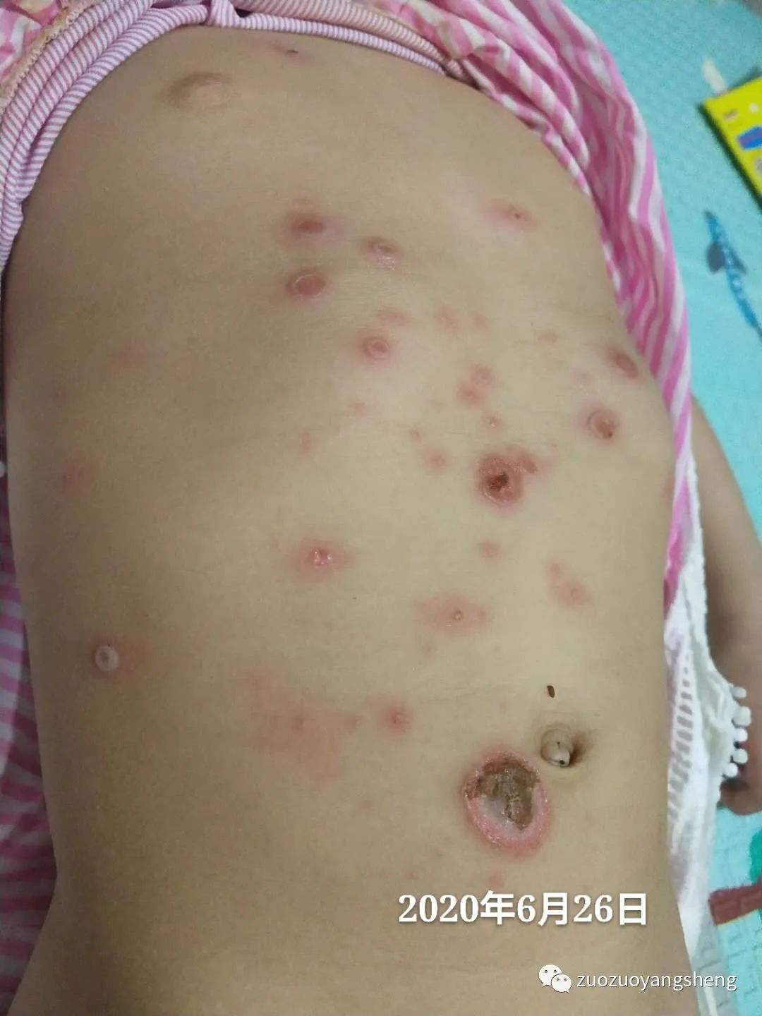 案例分享:原始点调理两岁儿童全身脓包溃烂流脓案例。 案例分享:原始点调理两岁儿童全身脓包溃烂流脓案例。