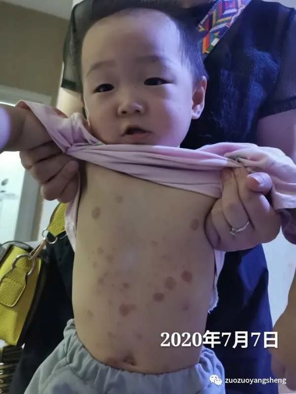 案例分享:原始点调理两岁儿童全身脓包溃烂流脓案例。 案例分享:原始点调理两岁儿童全身脓包溃烂流脓案例。