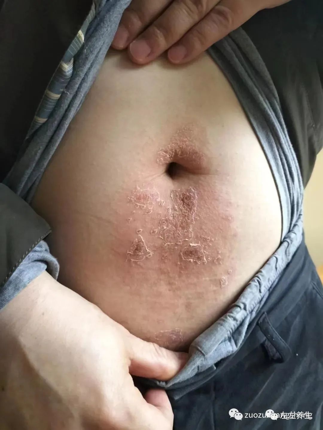 案例分享:腹部奇痒无比湿疹调理案例 案例分享:腹部奇痒无比湿疹调理案例