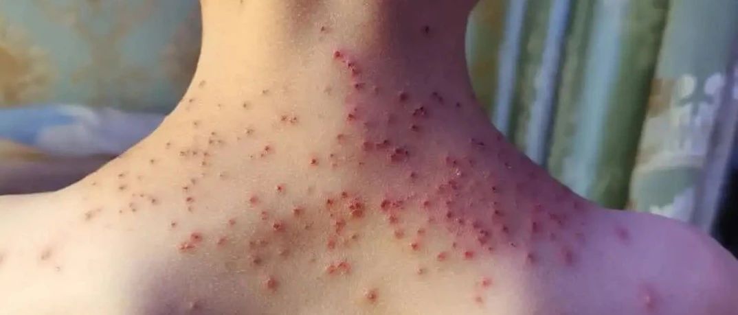 【原始点案例】原始点调理孩子水痘案例!-七不姜 生姜养生网-明德CSA生态姜园&明安农业