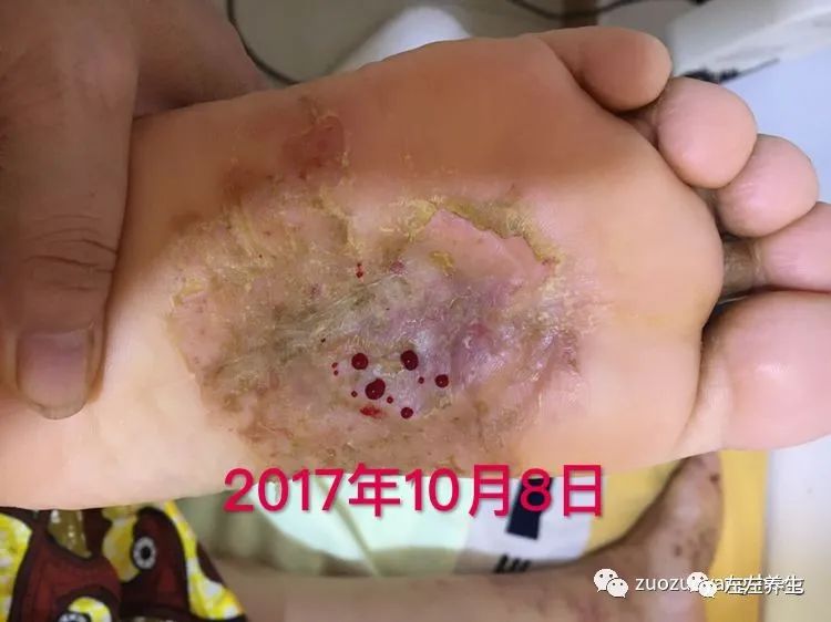 案例分享:全身奇痒无比的湿疹案例 案例分享:全身奇痒无比的湿疹案例