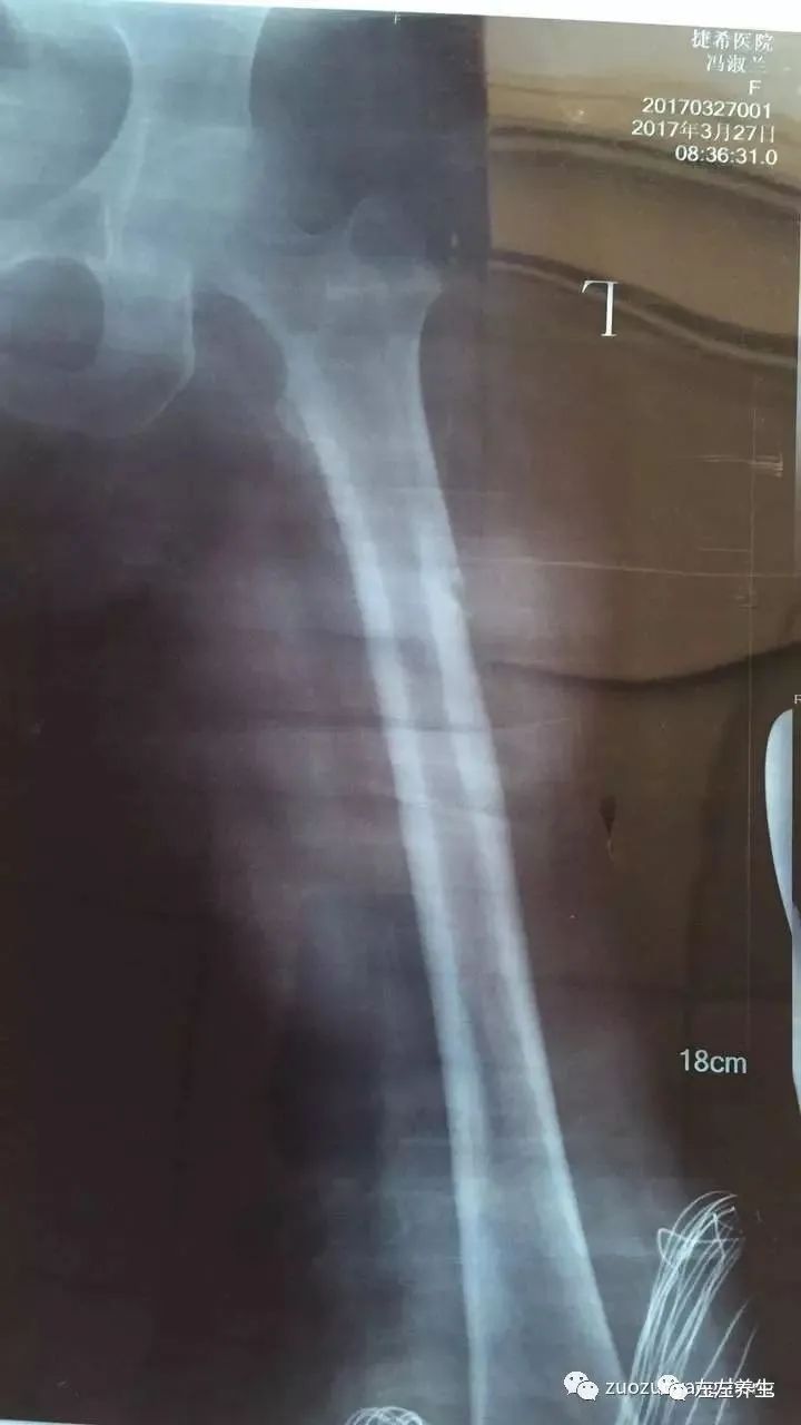 案例分享:又一奇迹:83岁婆婆骨折错位没开刀没手术6周康复 案例分享:又一奇迹:83岁婆婆骨折错位没开刀没手术6周康复