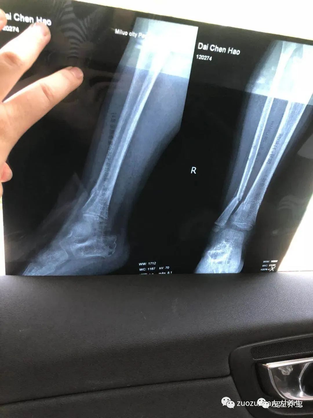 案例分享:三岁孩子右腿骨折调理案例 案例分享:三岁孩子右腿骨折调理案例