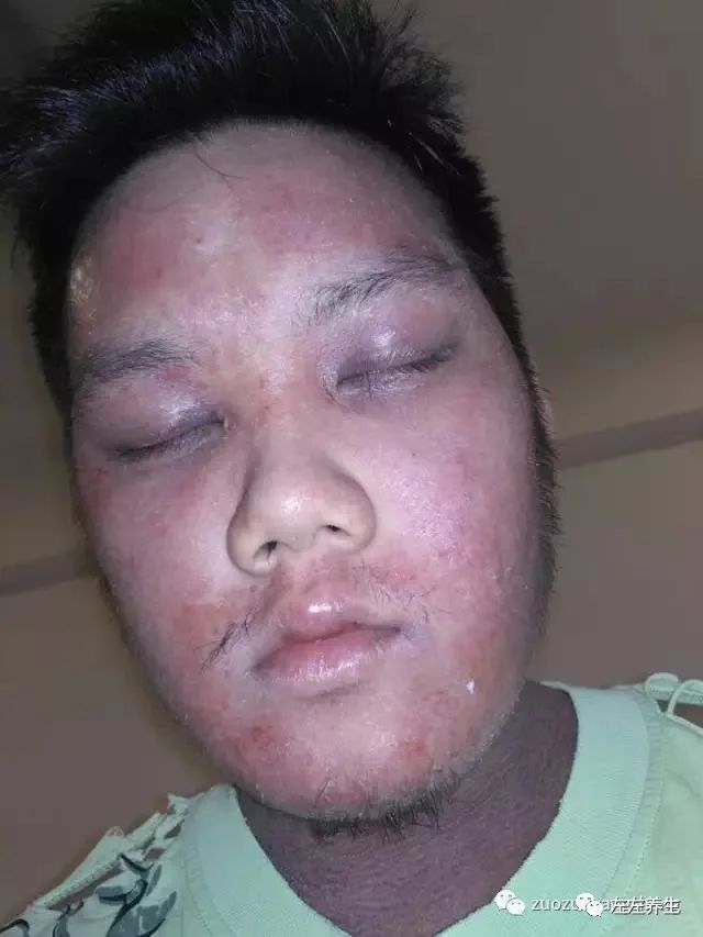 案例分享:马来西亚男孩严重湿疹、十天后大变样 案例分享:马来西亚男孩严重湿疹、十天后大变样