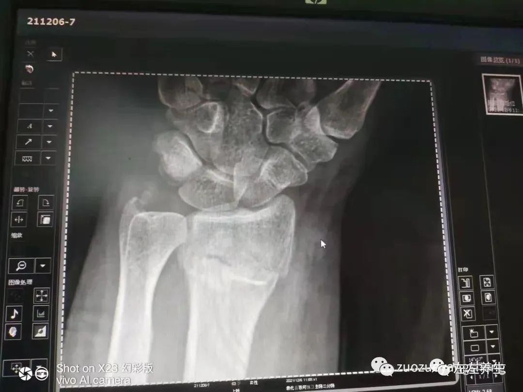 案例分享：挠骨骨折、错位，调理十天见效的案例