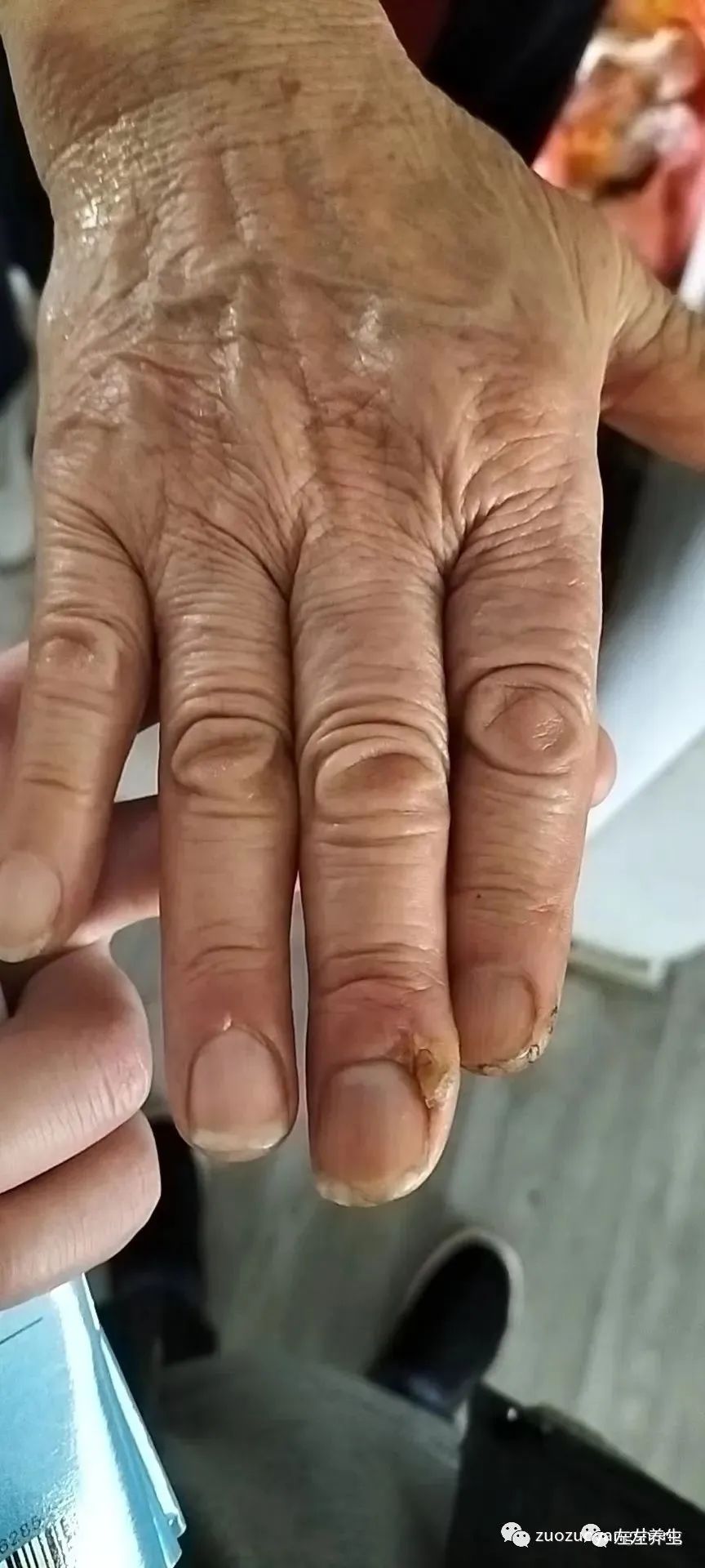 案例分享:手指夹伤后血流不止调理案例 案例分享:手指夹伤后血流不止调理案例