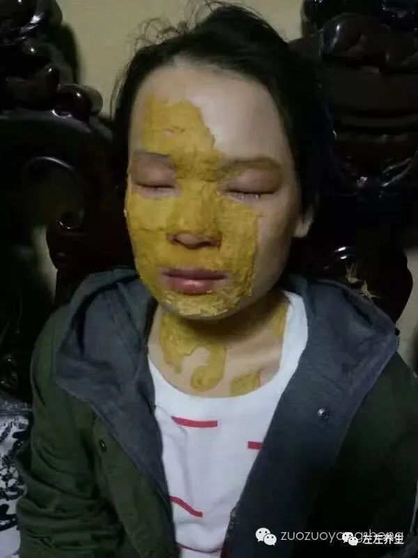 案例分享:花季少女面部烫伤不留疤的调理案例 案例分享:花季少女面部烫伤不留疤的调理案例