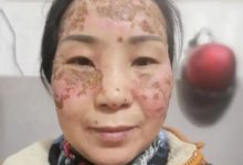 案例分享:脸上严重皮肤过敏调理案例-七不姜 生姜养生网-明德CSA生态姜园&明安农业