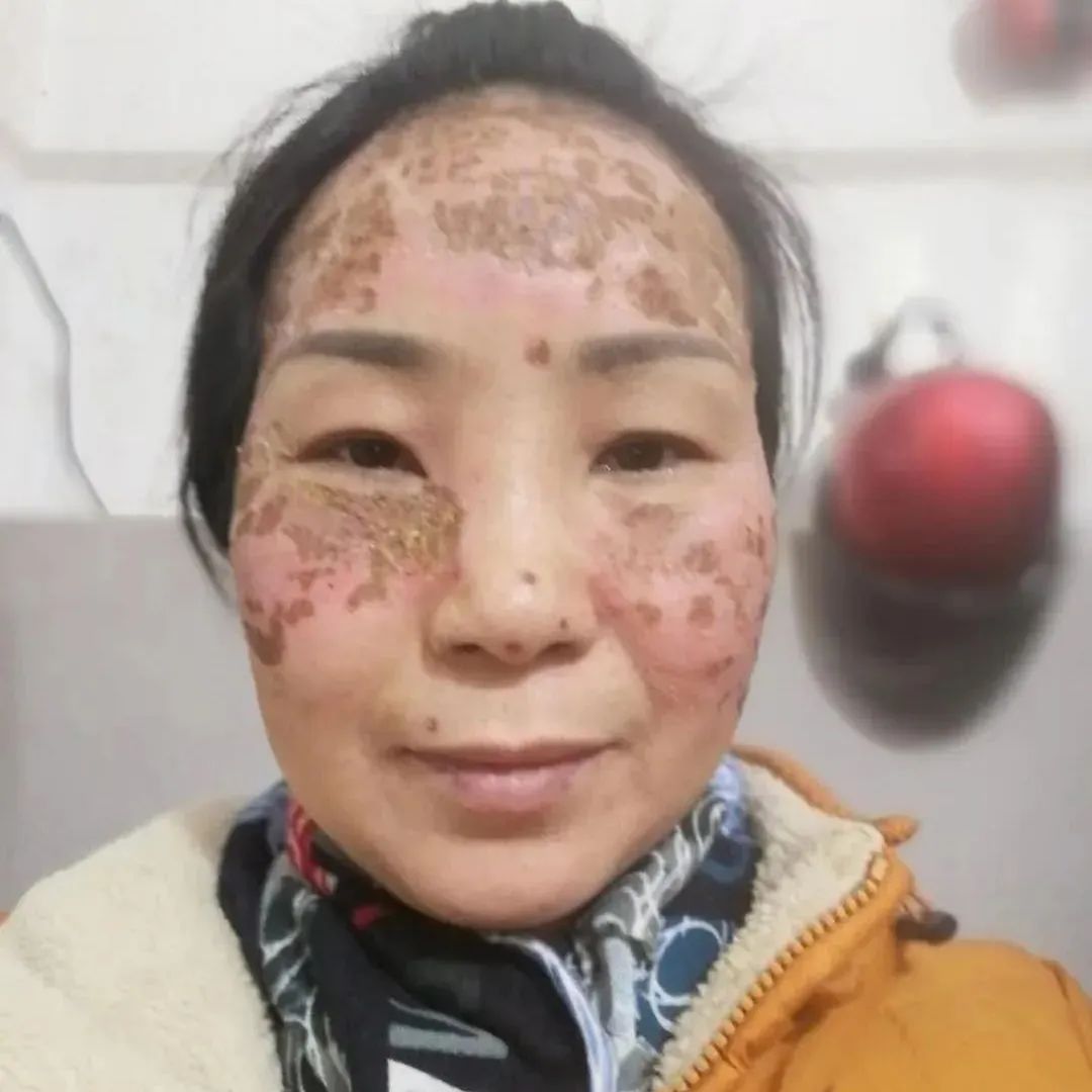 案例分享:脸上严重皮肤过敏调理案例-七不姜 生姜养生网-明德CSA生态姜园&明安农业