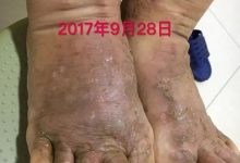 案例分享:全身奇痒无比的湿疹案例-七不姜 生姜养生网-明德CSA生态姜园&明安农业