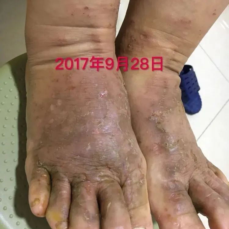 案例分享:全身奇痒无比的湿疹案例-七不姜 生姜养生网-明德CSA生态姜园&明安农业