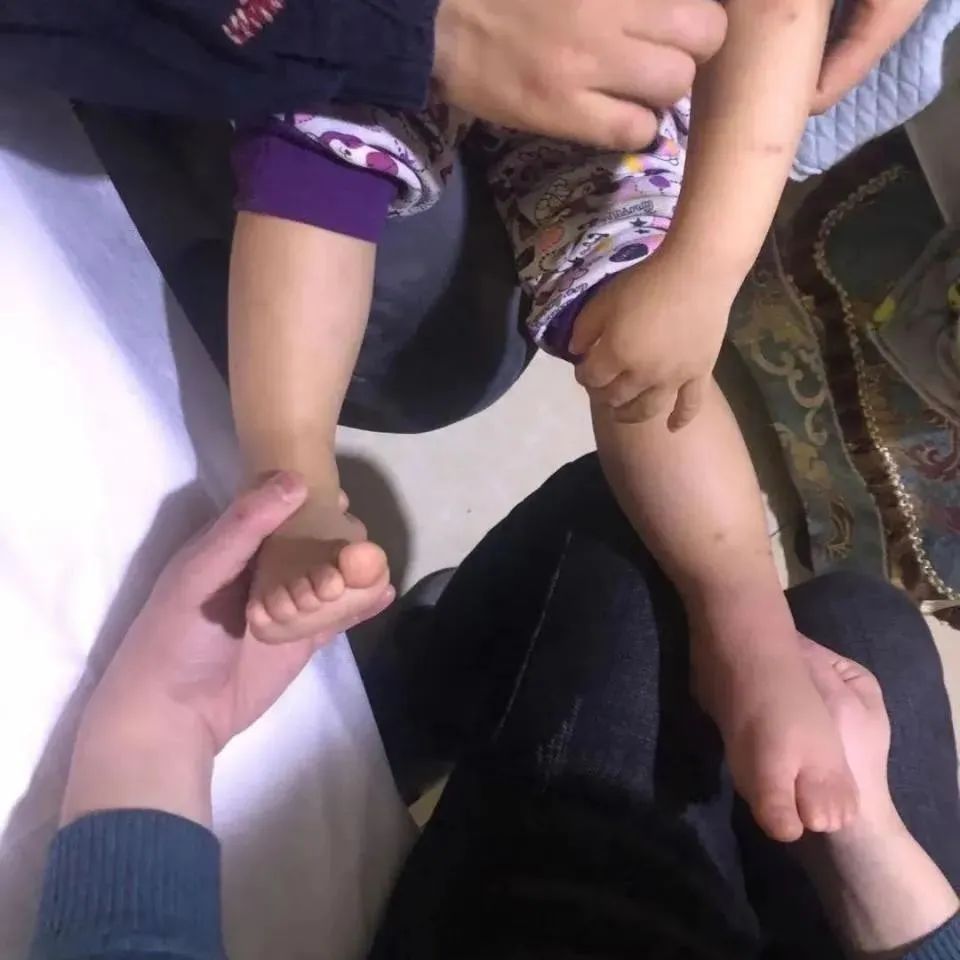 案例分享：原始点调理小孩荨麻疹调理案例-七不姜 生姜养生网-明德CSA生态姜园&明安农业