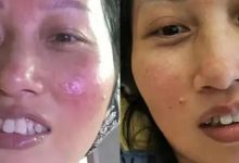 案例分享:脸上玫瑰痤疮调理案例-七不姜 生姜养生网-明德CSA生态姜园&明安农业