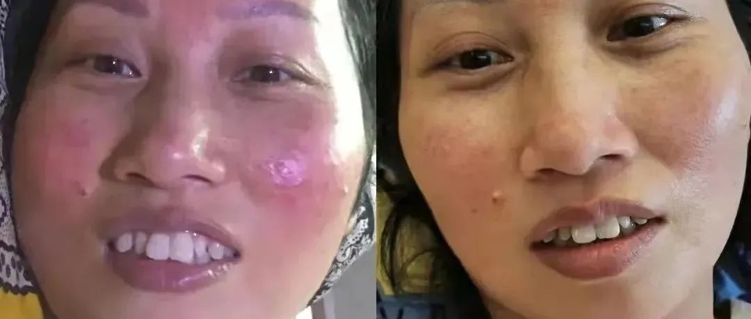 案例分享:脸上玫瑰痤疮调理案例-七不姜 生姜养生网-明德CSA生态姜园&明安农业