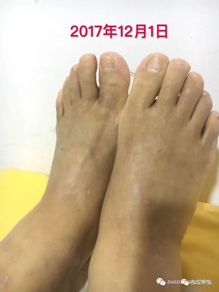 案例分享:全身奇痒无比的湿疹案例 案例分享:全身奇痒无比的湿疹案例