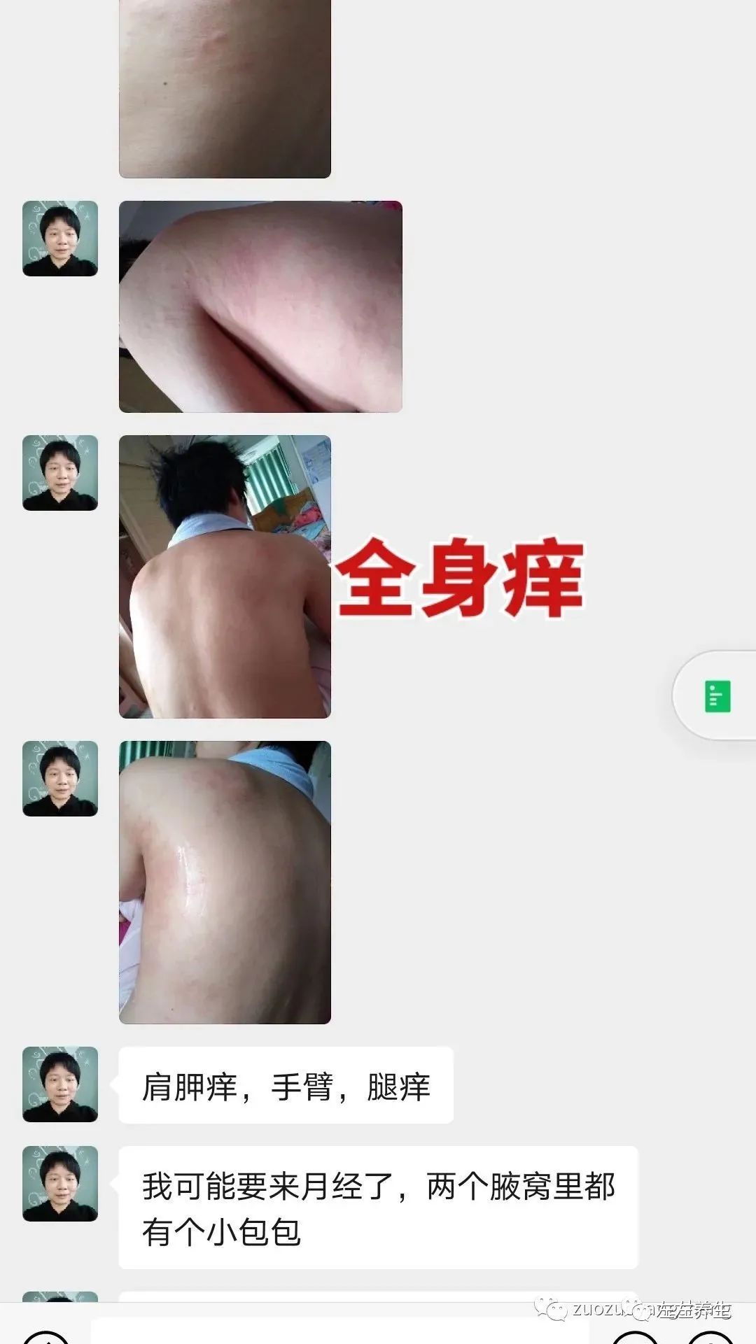 案例分享:调理荨麻疹的好转反应 案例分享:调理荨麻疹的好转反应