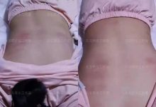 案例分享:20岁女孩脊柱严重侧弯、盆骨突出、走路高低脚的案例-七不姜 生姜养生网-明德CSA生态姜园&明安农业