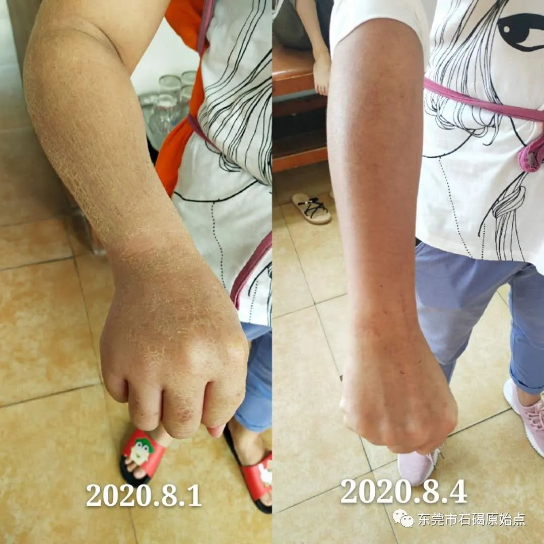 双手肿,胀痛,原始点调理3天康复 双手肿,胀痛,原始点调理3天康复