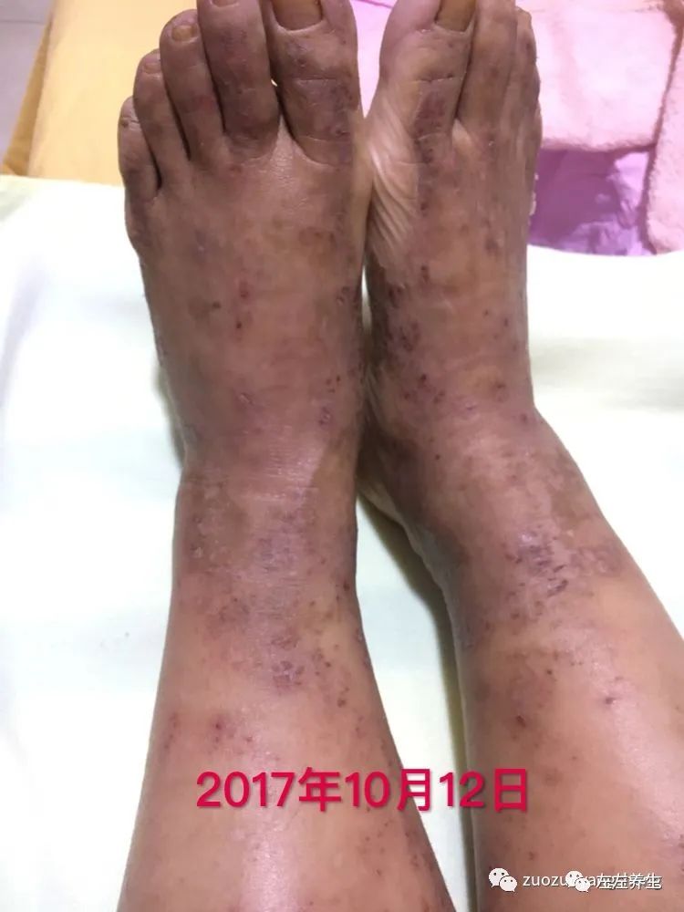 案例分享:全身奇痒无比的湿疹案例 案例分享:全身奇痒无比的湿疹案例