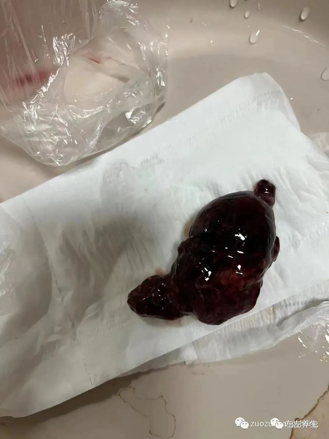 案例分享：胎停排死胎调理案例