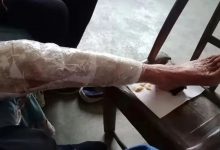 案例分享:85岁老人腿痛、无力,“种”发的案例-七不姜 生姜养生网-明德CSA生态姜园&明安农业