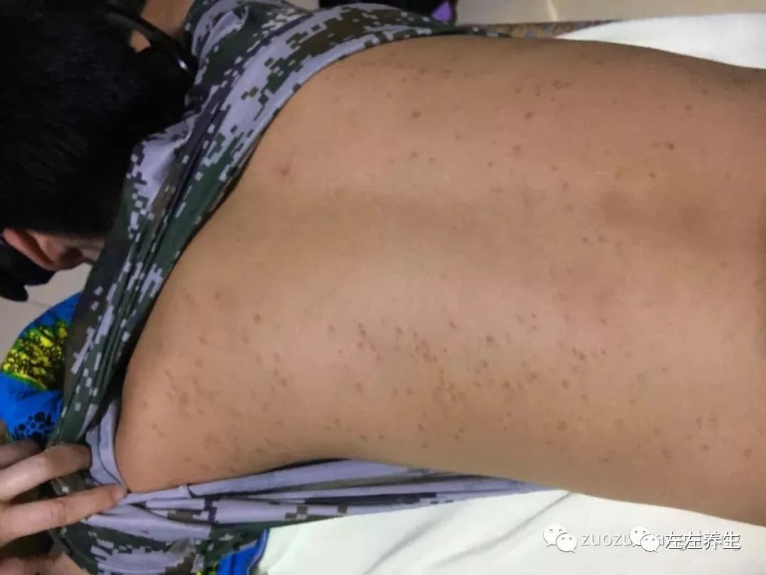 案例分享:14岁少年毛囊炎、全身痒、长痘痘的案例 案例分享:14岁少年毛囊炎、全身痒、长痘痘的案例